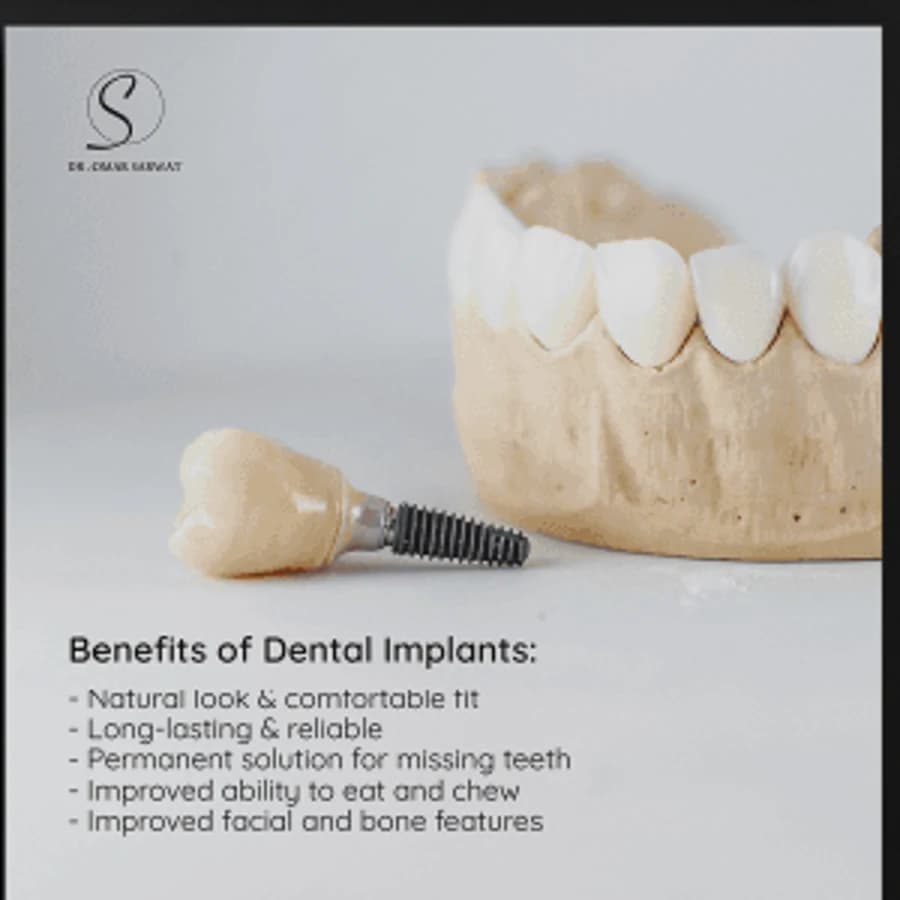 Dental implant educational social post for Dr. Omar Sarwat